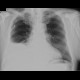 Pleural effusion: X-ray - Plain radiograph